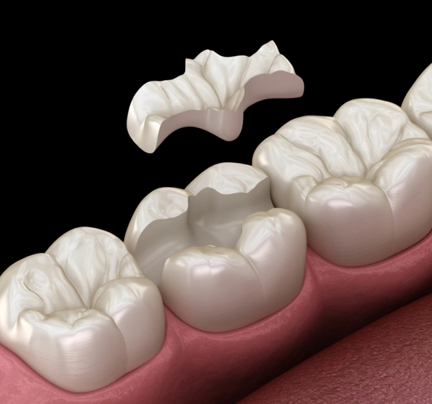 Dental clinic for Inlays and Onlays in Waco