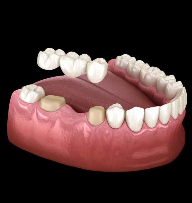 Restore Your Smile with Dental Bridges in Waco