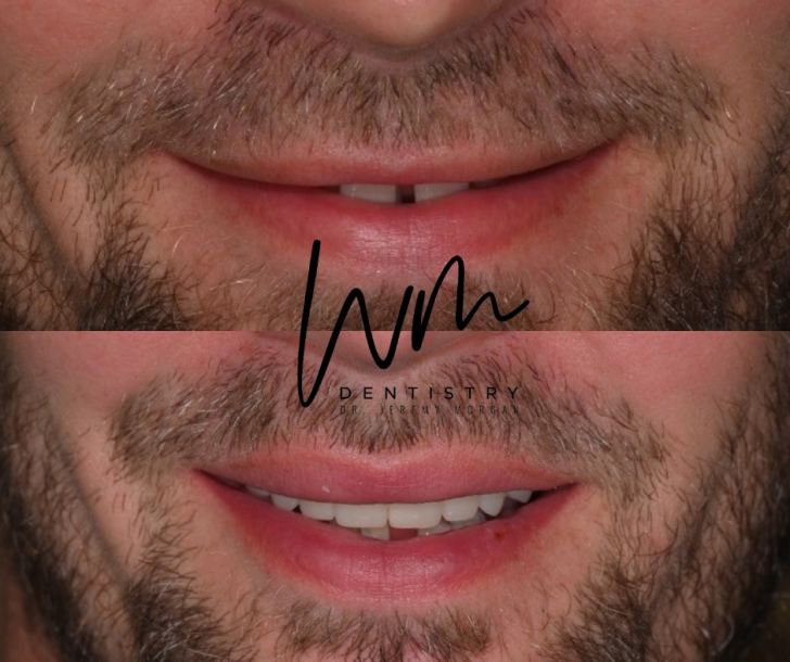 Smile Makeover Before and After