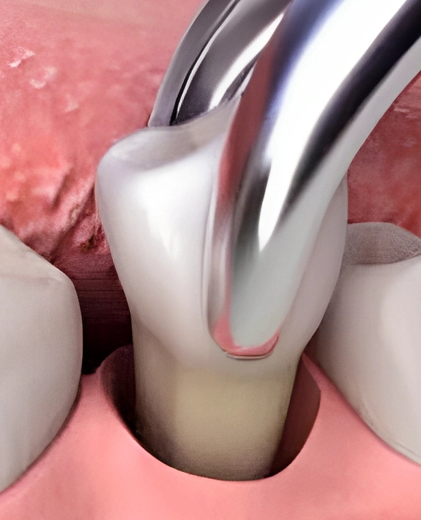 Close-up of tooth extraction procedure in Waco dental office